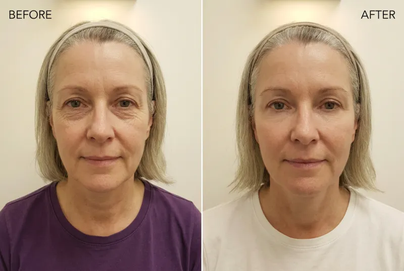 Crepey Under Eye Skin — Female, 50s - Before and After
