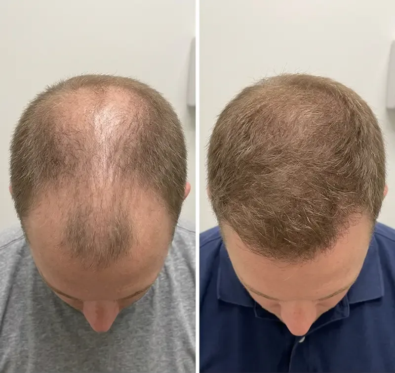 Hair restoration before and after - thinning crown treated with exosome microneedling at AURA by Lara
