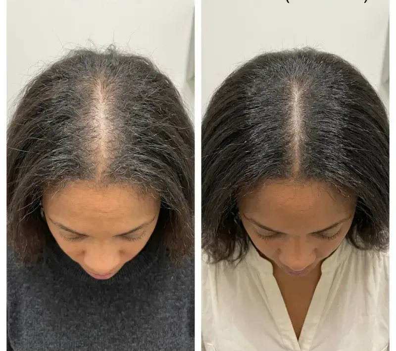 Stress-Related Hair Thinning — Female, 40s - Before and After