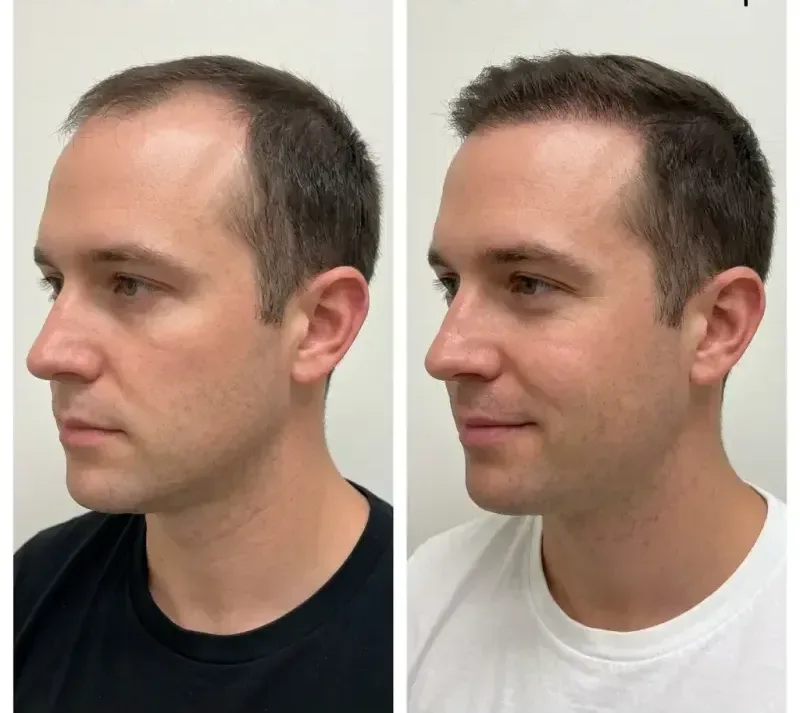 Hair restoration before and after receding temples treated at AURA by Lara Chelmsford