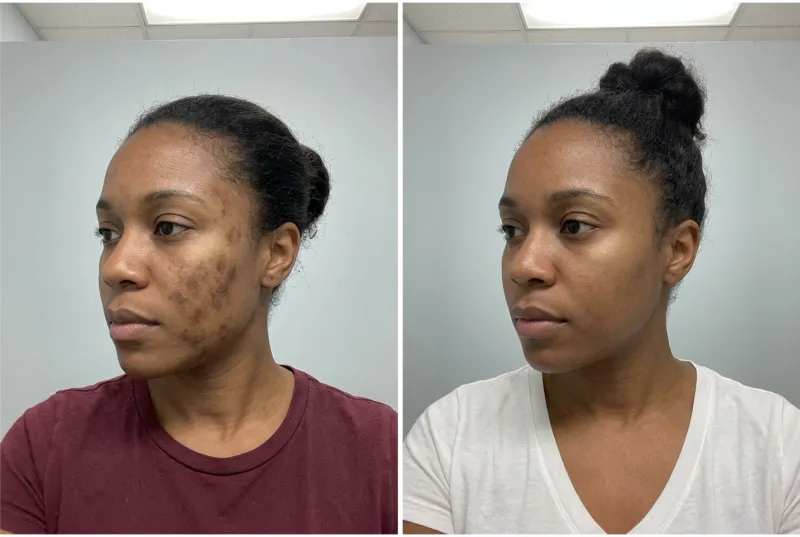 Post-Inflammatory Hyperpigmentation — Female, 30s - Before and After