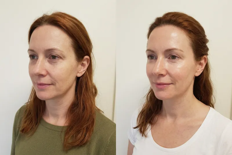 Dull, Tired Complexion — Female, 40s - Before and After